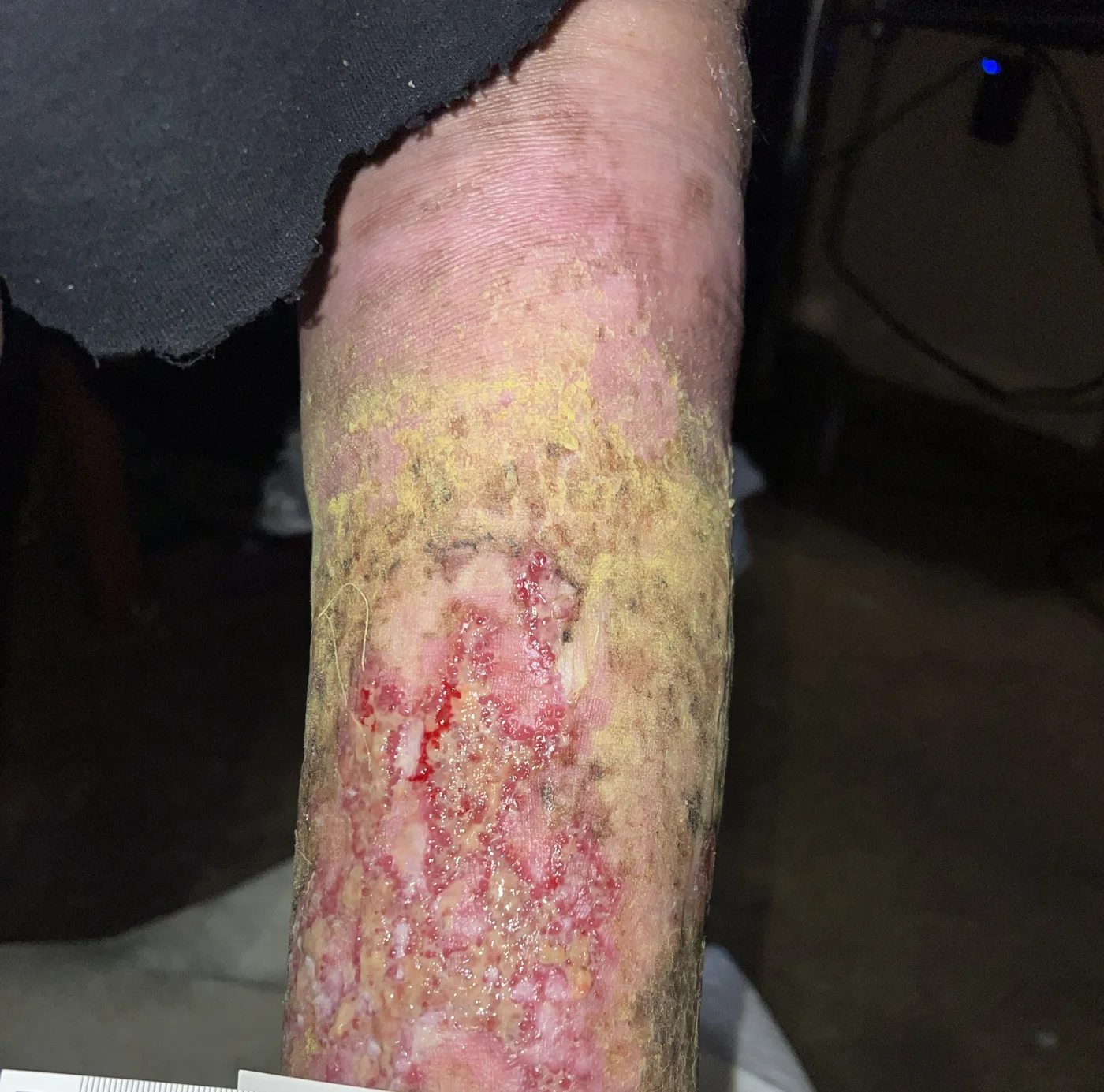 Open venous wound